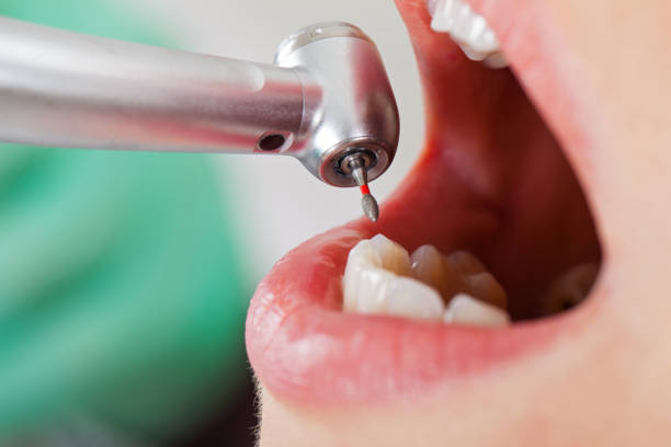 Best Emergency Tooth Extraction  in Springfield, NE